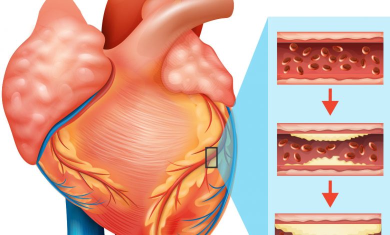 Unhealthy Food and Unhealthy Lifestyle Main causes of Heart Diseases