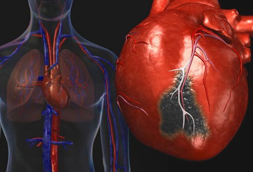 An Ayurvedic approach to cardiology
