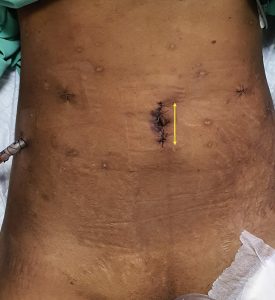 Robotic Kidney Transplant