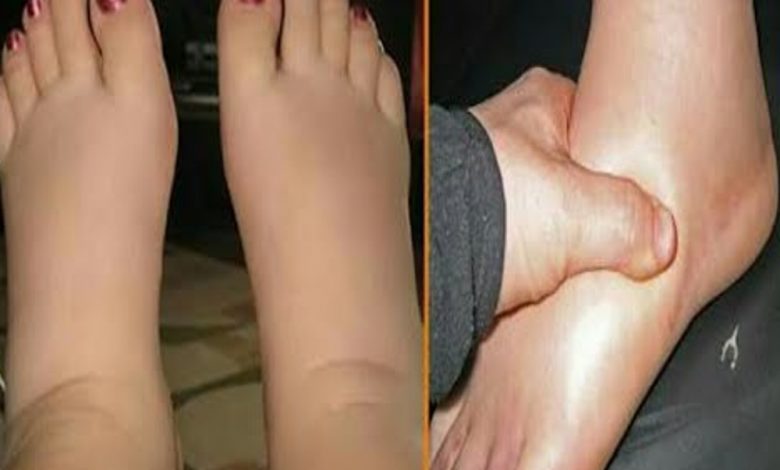 समय से खा लें दवाई, नहीं होगा फायलेरिया