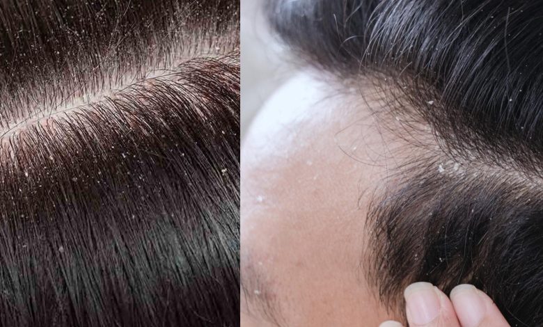 डैंड्रफ से छुटकारा कैसे पाए