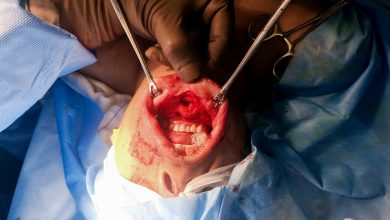 Photo of SGPGI Lucknow  performs Trans – Oral Robotic Surgery